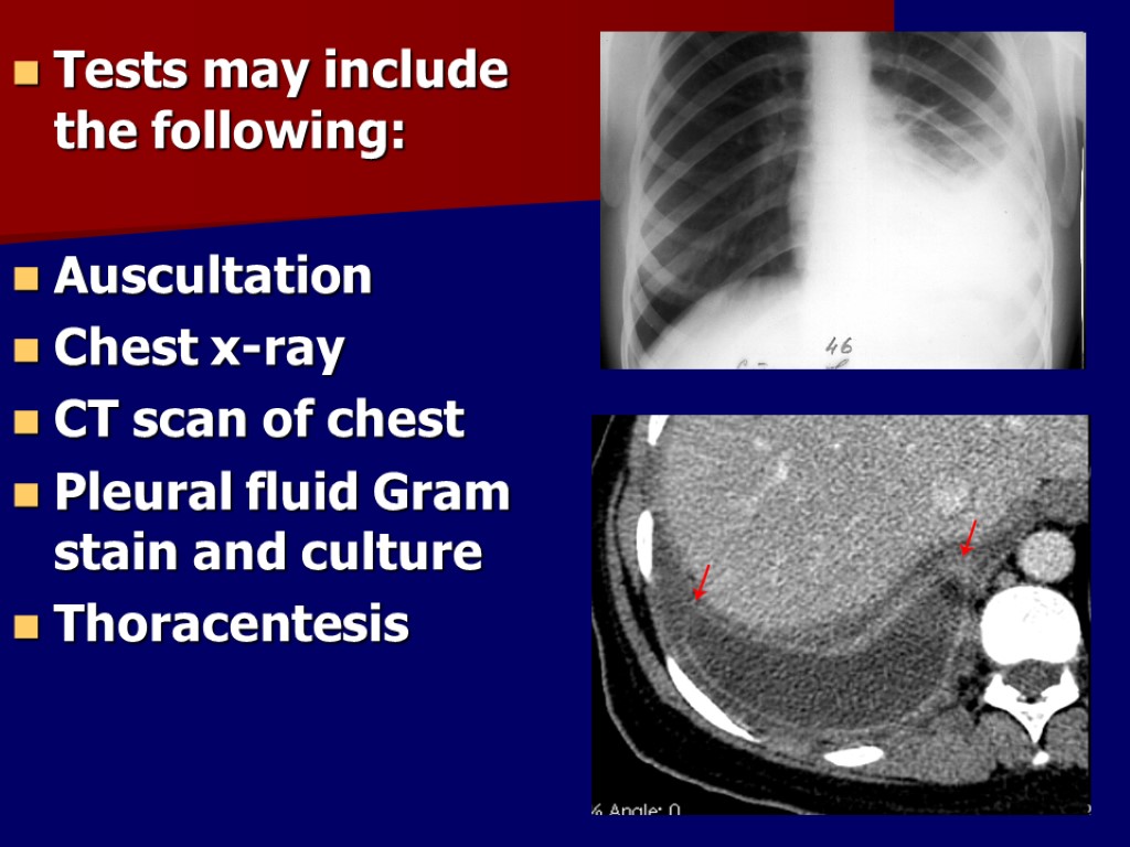 Tests may include the following: Auscultation Chest x-ray CT scan of chest Pleural fluid